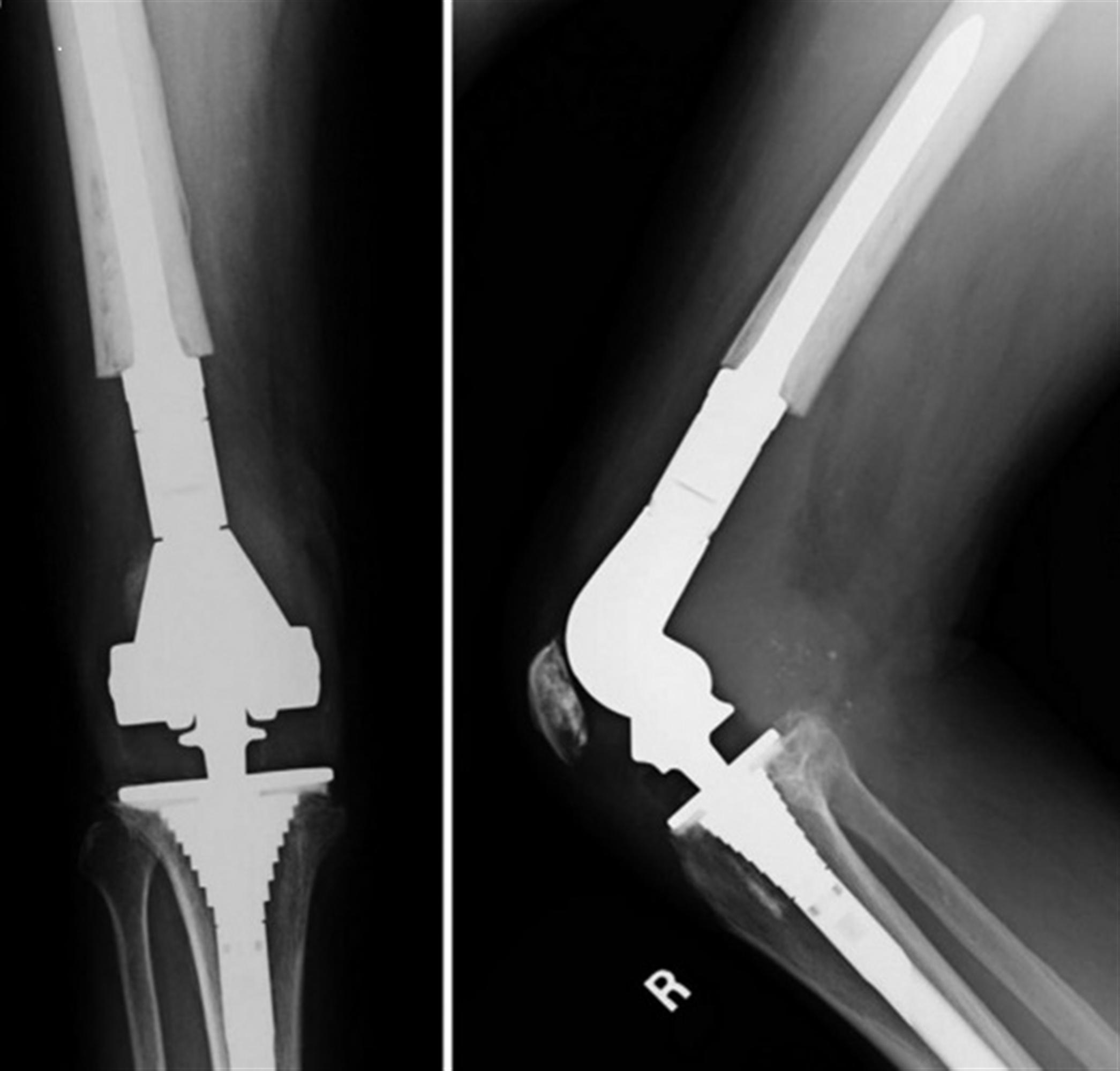 TKA Prosthesis Design Recon Orthobullets